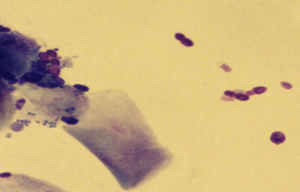 マラセチア性皮膚炎　顕微鏡写真